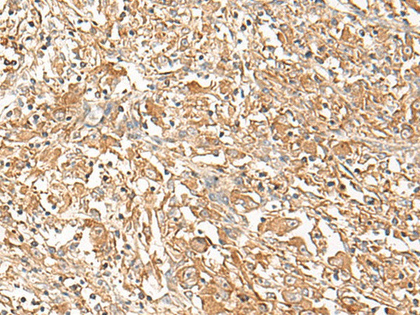 Immunohistochemistry of paraffin-embedded Human liver cancer tissue using CORO2A Polyclonal Antibody at dilution of 1:50(×200)