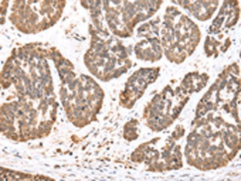 Immunohistochemistry of paraffin-embedded Human esophagus cancer tissue using DDX58 Polyclonal Antibody at dilution of 1:35(×200)