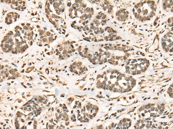 Immunohistochemistry of paraffin-embedded Human esophagus cancer tissue using BRD7 Polyclonal Antibody at dilution of 1:50(×200)