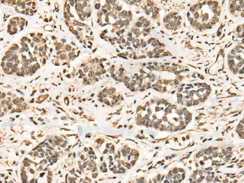 Immunohistochemistry of paraffin-embedded Human esophagus cancer tissue using BRD7 Polyclonal Antibody at dilution of 1:50(×200)
