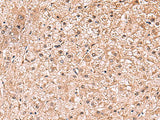Immunohistochemistry of paraffin-embedded Human liver cancer tissue using RUSC1 Polyclonal Antibody at dilution of 1:90(×200)