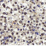 Immunohistochemistry analysis of paraffin-embedded human orchidoncus using Cyclin E1 Polyclonal Antibody at dilution of 1:400.