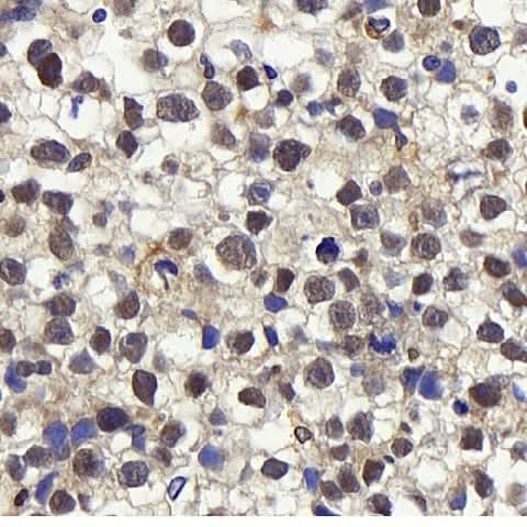 Immunohistochemistry analysis of paraffin-embedded human orchidoncus using Cyclin E1 Polyclonal Antibody at dilution of 1:400.