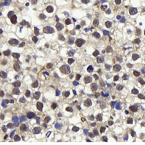 Immunohistochemistry analysis of paraffin-embedded human orchidoncus using Cyclin E1 Polyclonal Antibody at dilution of 1:400.