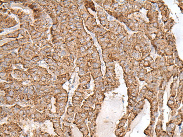 Immunohistochemistry of paraffin-embedded Human thyroid cancer tissue using AP1S1 Polyclonal Antibody at dilution of 1:65(×200)