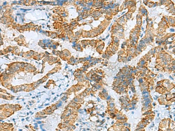Immunohistochemistry of paraffin-embedded Human thyroid cancer tissue using FBXO8 Polyclonal Antibody at dilution of 1:40(×200)