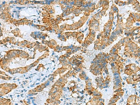 Immunohistochemistry of paraffin-embedded Human thyroid cancer tissue using FBXO8 Polyclonal Antibody at dilution of 1:40(×200)
