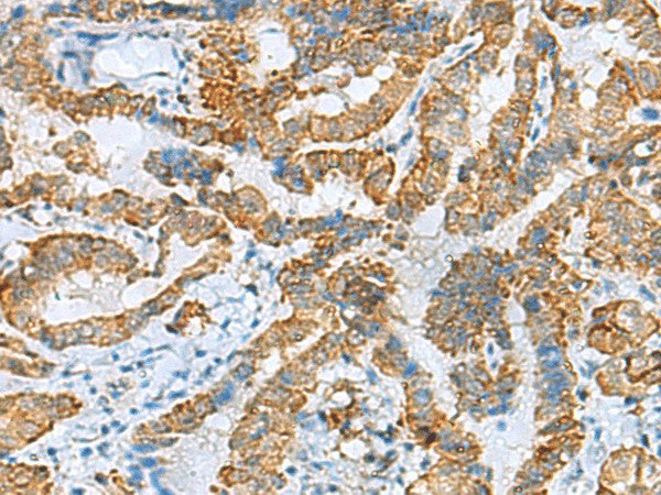 Immunohistochemistry of paraffin-embedded Human thyroid cancer tissue using FBXO8 Polyclonal Antibody at dilution of 1:40(×200)