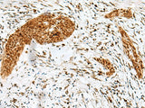Immunohistochemistry of paraffin-embedded Human esophagus cancer tissue using HMG20A Polyclonal Antibody at dilution of 1:25(×200)