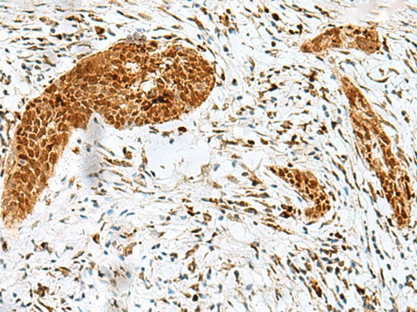 Immunohistochemistry of paraffin-embedded Human esophagus cancer tissue using HMG20A Polyclonal Antibody at dilution of 1:25(×200)