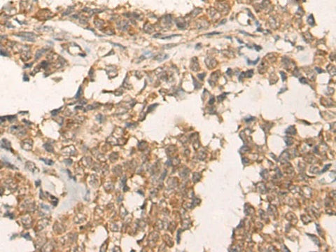 Immunohistochemistry of paraffin-embedded Human ovarian cancer tissue using ATR Polyclonal Antibody at dilution of 1:60(×200)