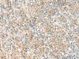 Immunohistochemistry of paraffin-embedded Human cervical cancer tissue using PSD4 Polyclonal Antibody at dilution of 1:50(×200)