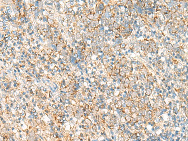 Immunohistochemistry of paraffin-embedded Human cervical cancer tissue using PSD4 Polyclonal Antibody at dilution of 1:50(×200)
