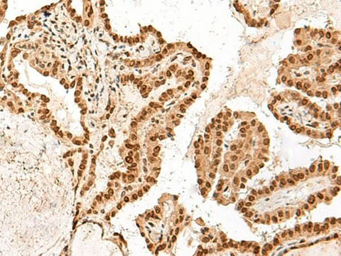Immunohistochemistry of paraffin-embedded Human thyroid cancer tissue using ARMC8 Polyclonal Antibody at dilution of 1:60(×200)