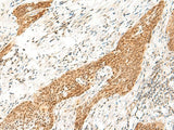 Immunohistochemistry of paraffin-embedded Human esophagus cancer tissue using RPS27A Polyclonal Antibody at dilution of 1:35(×200)