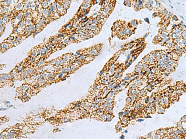 Immunohistochemistry of paraffin-embedded Human gastric cancer tissue using PYCR2 Polyclonal Antibody at dilution of 1:40(×200)