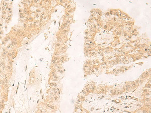 Immunohistochemistry of paraffin-embedded Human liver cancer tissue using RBX1 Polyclonal Antibody at dilution of 1:30(×200)