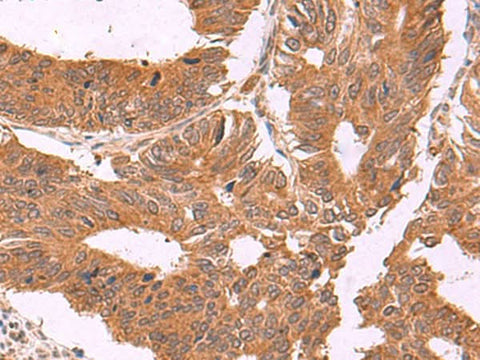 Immunohistochemistry of paraffin-embedded Human colorectal cancer tissue using ZBTB33 Polyclonal Antibody at dilution of 1:30(×200)