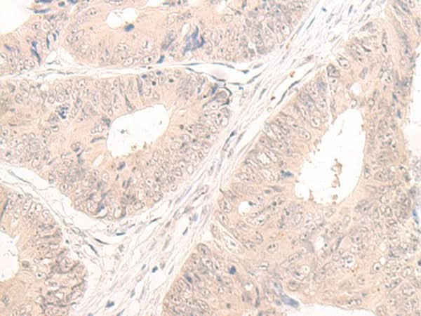 Immunohistochemistry of paraffin-embedded Human colorectal cancer tissue using LCMT2 Polyclonal Antibody at dilution of 1:55(×200)