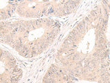Immunohistochemistry of paraffin-embedded Human colorectal cancer tissue using LCMT2 Polyclonal Antibody at dilution of 1:55(×200)