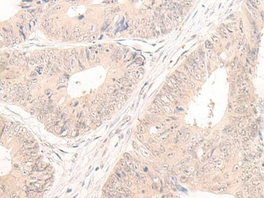 Immunohistochemistry of paraffin-embedded Human colorectal cancer tissue using LCMT2 Polyclonal Antibody at dilution of 1:55(×200)