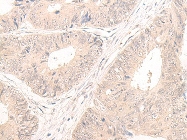 Immunohistochemistry of paraffin-embedded Human colorectal cancer tissue using LCMT2 Polyclonal Antibody at dilution of 1:55(×200)