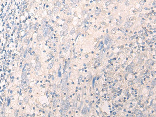 Immunohistochemistry of paraffin-embedded Human cervical cancer tissue using LILRA2 Polyclonal Antibody at dilution of 1:40(×200)