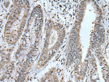 Immunohistochemistry of paraffin-embedded Human liver cancer tissue using UBA52 Polyclonal Antibody at dilution of 1:55(×200)