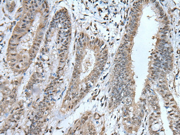 Immunohistochemistry of paraffin-embedded Human liver cancer tissue using UBA52 Polyclonal Antibody at dilution of 1:55(×200)