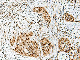 Immunohistochemistry of paraffin-embedded Human esophagus cancer tissue using RBM10 Polyclonal Antibody at dilution of 1:50(×200)