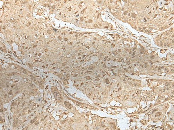 Immunohistochemistry of paraffin-embedded Human esophagus cancer tissue using ZBTB18 Polyclonal Antibody at dilution of 1:50(×200)