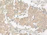 Immunohistochemistry of paraffin-embedded Human lung cancer tissue using GPR161 Polyclonal Antibody at dilution of 1:40(×200)