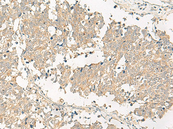 Immunohistochemistry of paraffin-embedded Human lung cancer tissue using GPR161 Polyclonal Antibody at dilution of 1:40(×200)