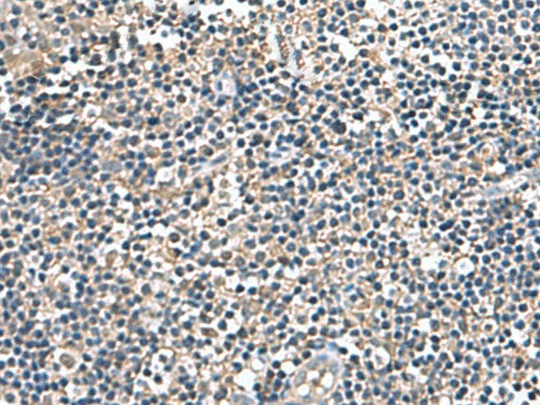 Immunohistochemistry of paraffin-embedded Human tonsil tissue using IP6K2 Polyclonal Antibody at dilution of 1:140(×200)
