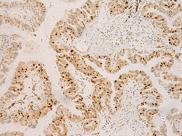 Immunohistochemistry of paraffin-embedded Human liver cancer tissue using RFX6 Polyclonal Antibody at dilution of 1:50(×200)