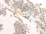 Immunohistochemistry of paraffin-embedded Human ovarian cancer tissue using IBA57 Polyclonal Antibody at dilution of 1:65(×200)