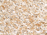 Immunohistochemistry of paraffin-embedded Human liver cancer tissue using RAB38 Polyclonal Antibody at dilution of 1:50(×200)