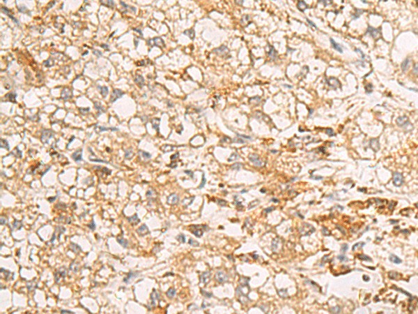 Immunohistochemistry of paraffin-embedded Human liver cancer tissue using RAB38 Polyclonal Antibody at dilution of 1:50(×200)