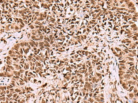 Immunohistochemistry of paraffin-embedded Human ovarian cancer tissue using LDB1 Polyclonal Antibody at dilution of 1:70(×200)