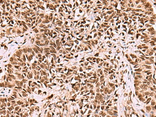 Immunohistochemistry of paraffin-embedded Human ovarian cancer tissue using LDB1 Polyclonal Antibody at dilution of 1:70(×200)