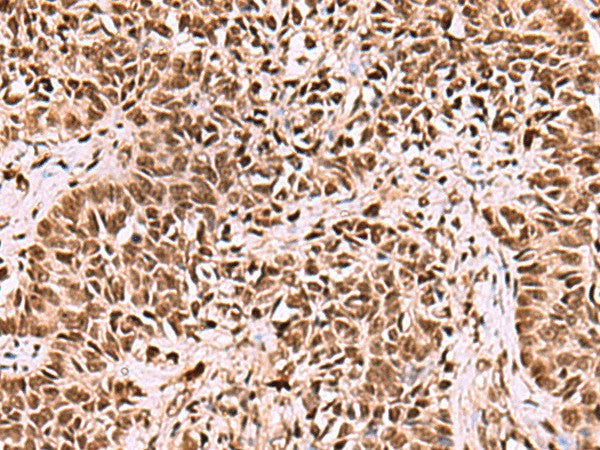 Immunohistochemistry of paraffin-embedded Human ovarian cancer tissue using LDB1 Polyclonal Antibody at dilution of 1:70(×200)