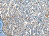 Immunohistochemistry of paraffin-embedded Human liver cancer tissue using CAPN3 Polyclonal Antibody at dilution of 1:30(×200)