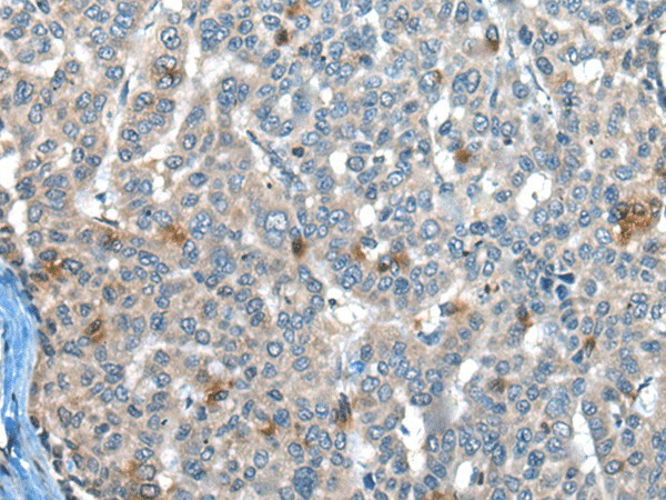 Immunohistochemistry of paraffin-embedded Human liver cancer tissue using CAPN3 Polyclonal Antibody at dilution of 1:30(×200)