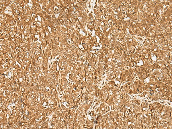 Immunohistochemistry of paraffin-embedded Human ovarian cancer tissue using GMEB2 Polyclonal Antibody at dilution of 1:35(×200)