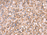 Immunohistochemistry of paraffin-embedded Human liver cancer tissue using KCNN1 Polyclonal Antibody at dilution of 1:55(×200)