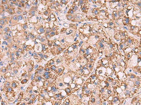 Immunohistochemistry of paraffin-embedded Human liver cancer tissue using KCNN1 Polyclonal Antibody at dilution of 1:55(×200)