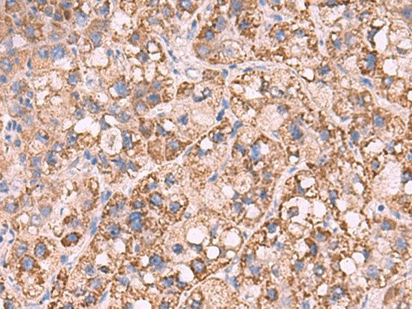 Immunohistochemistry of paraffin-embedded Human liver cancer tissue using KCNN1 Polyclonal Antibody at dilution of 1:55(×200)