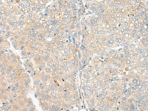 Immunohistochemistry of paraffin-embedded Human liver cancer tissue using CAMK2A Polyclonal Antibody at dilution of 1:55(×200)