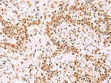 Immunohistochemistry of paraffin-embedded Human ovarian cancer tissue using GPKOW Polyclonal Antibody at dilution of 1:100(×200)