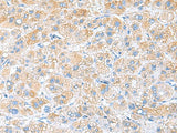Immunohistochemistry of paraffin-embedded Human liver cancer tissue using RPS16 Polyclonal Antibody at dilution of 1:65(×200)